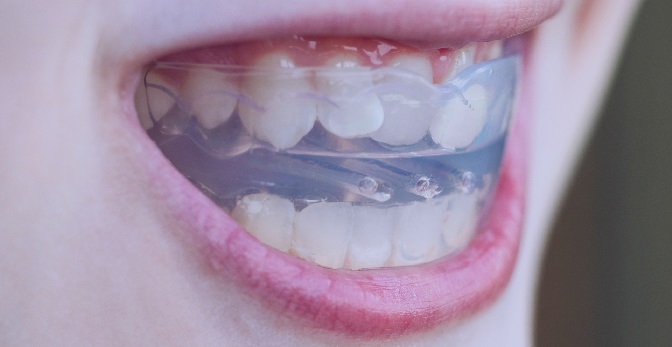 Scientific Marvel of Invisalign